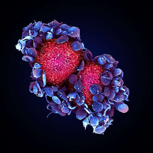 Les plaquettes (en bleu/violet) qui s’attachent à deux cellules tumorales (en rouge) dans un modèle pré-clinique de souris © Maria Jésus García León (Inserm unité 1109/Université de Strasbourg)