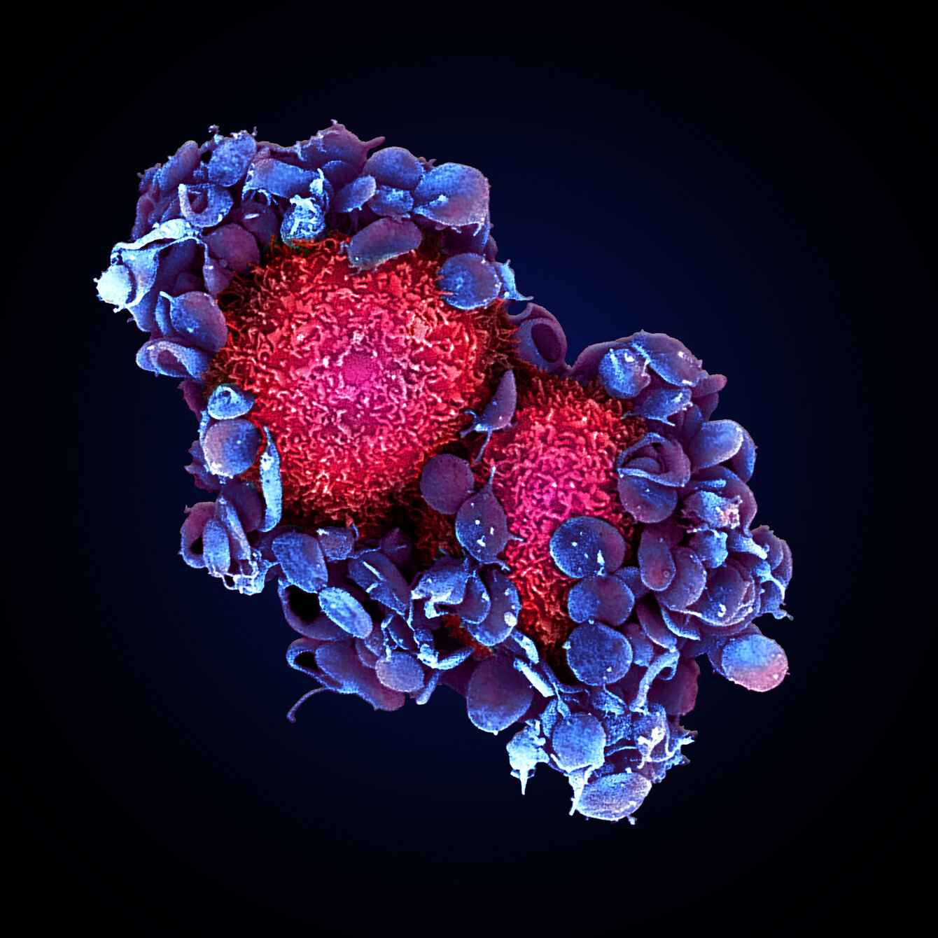 Breast cancer tumor cells ‘shielded’ by blood platelets_U1109©Maria Jesūs Garcia Leon