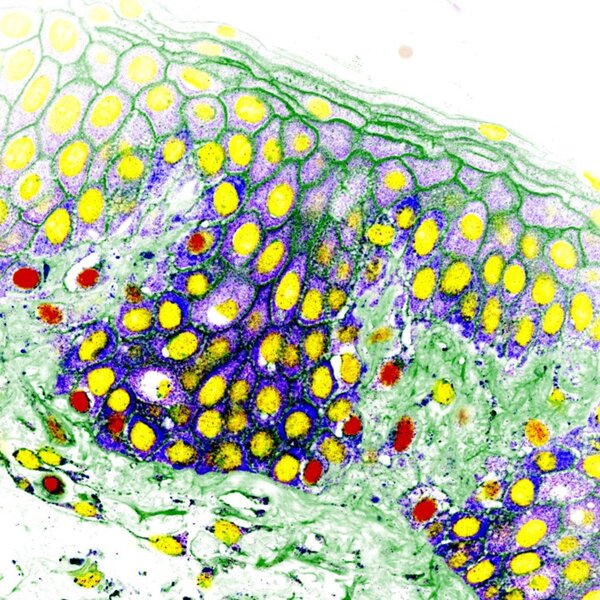 Human skin - benign tissue (nevus) ©Katerina Jerabkova-Roda Human skin - benign tissue (nevus) ©Katerina Jerabkova-Roda