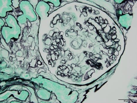 Image histologique d’un rejet de greffe rénale médié par des anticorps. ©Sophie Caillard/Jérome Olagne, Inserm U 1109